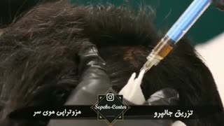 تزریق مزوتراپی موی سر و جالپرو
