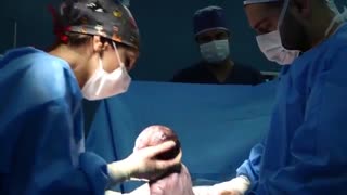 عمل جراحی سزارین