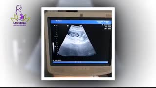 فیلم واقعی سونوگرافى حاملگى به دنبال iui دوقلویى در فرد با تخمدان پلى کیستیک