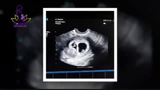 فیلم حاملگی دو قلویی حاصل آى وى اف در فردی با سابقه ناباروری با فاکتور مردانه