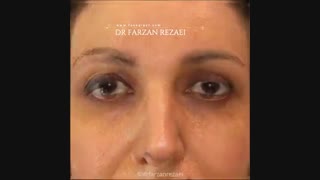 فیلم  لیفت ابرو