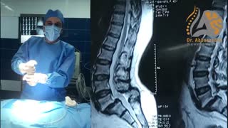 فیلم واقعی جراحى سرخوردگى مهره