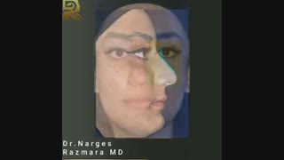 نمونه بینی طبیعی دو سال بعد از عمل