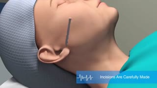 انیمیشن جراحی لیفت صورت ترمیم ونیر