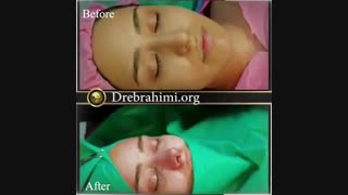 جراحی زیبایی بینی توسط دکتر امید ابراهیمی بهترین جراح بینی در تهران