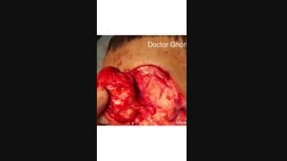 تومور لاله گوش