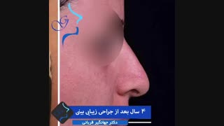 4 سال بعد از جراحی بینی