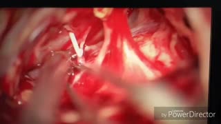 تومور عصبی شنوایی