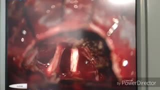 تومور مننژیوم بزرگ زاویه پلی مخچه ای