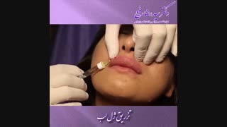 تزریق ژل لب توسط دکتر سید رضا رفیع | جراح پلاستیک