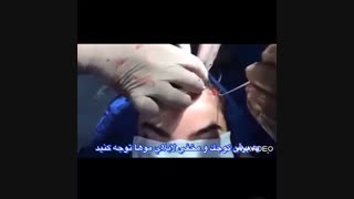 لیفت آندوسکوپیک ابرو | پروفسور کشکولی | فوق تخصص جراحی پلاستیک چشم