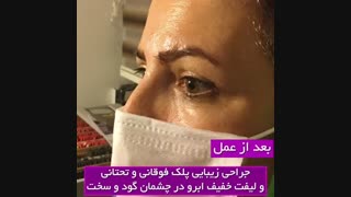 جراحی زیبایی پلک فوقانی و تحتانی