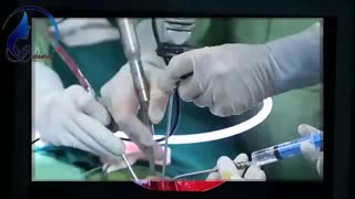 نشت مایع مغزی از بینی