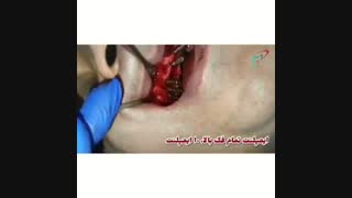 ایمپلنت تمام فک بالا