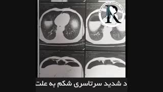 جراحی ترمیمی معده