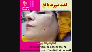 لیفت صورت با نخ