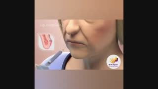 فیلم جالب تزریق ژل لب دندانپزشک زیبایی