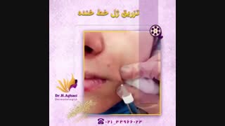 فیلم تزریق ژل خط خنده لیزر موهای زائد