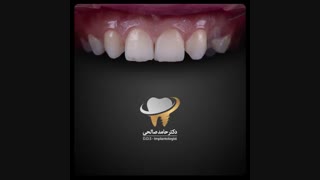 درمان ترکیبی ایمپلنت و لمینت سرامیکی | دکتر حامد سرامیکی