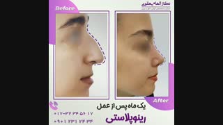 یکماه پس از رینوپلاستی