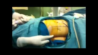 نحوه ی انجام عمل pcnl کلیه