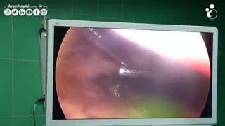 جراحی کیسه صفرا