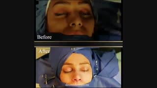 بلافاصله بعد از عمل بینی، توسط دکتر امید ابراهیمی بهترین جراح بینی در تهران