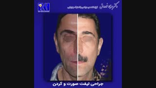 جراحی لیفت صورت و گردن
