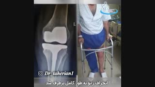 اقای 67 سال با ارتروز و انحراف شدید زانوی چپ | متخصص ارتوپد | دکتر محمدابراهیم طاهریان