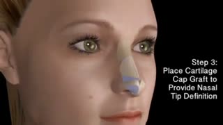 فیلمی جالب از جراحی بینی