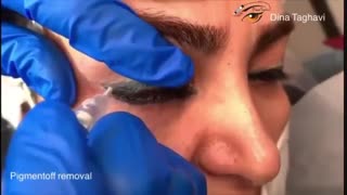 پاک کردن تاتو خط چشم