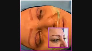 جراحی پلک بالا بدون بیهوشی