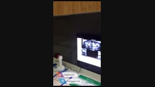 کاشت 2 واحد ایمپلنت دندان بدون شکافتن لثه