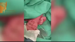 فیلم زایمان سزارین دوقلوها