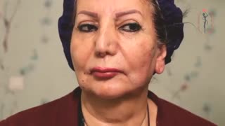 لیفت صورت با نخ