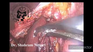 کله سیستکتومی در کیسه صفرا چروکیده