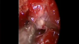 جراحی آندوسکوپی آدنوم هیپوفیز