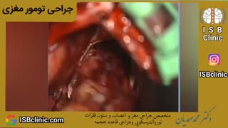 جراحی تومور مغزی