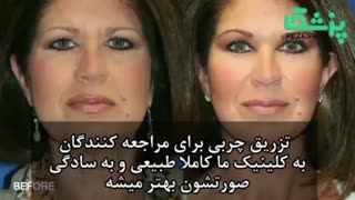 تزریق چربی به صورت به چه شکل انجام میشود؟