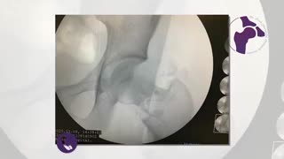 شکستگی گردن ران