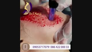 فیلم واقعی و بدون سانسور میکرونیدلینگ همراه با درمان های ترکیبی برای درمان جای زخم ارتودنسی