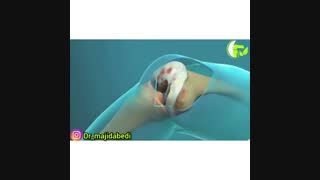 انیمیشن تعویض مفصل زانو