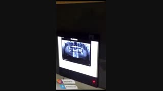 کاشت 16 واحد ایمپلنت دندان در یک جلسه توسط دکتر شهرام اسعدی بررسی لک صورت