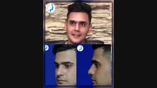 رضایت بیمار سه سال بعد از جراحی زیبایی بینی