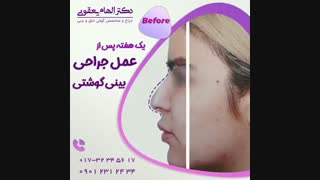 یک هفته پس از عمل بینی گوشتی