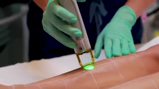 لیزر موهای زائد توسط دستگاه الکساندرایت