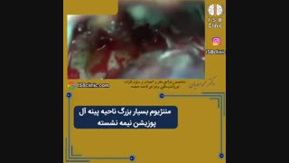 مننژیوم بزرگ