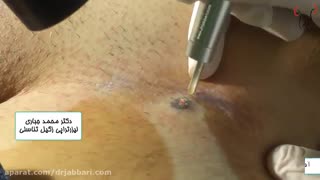 لیزر زگیل تناسلی