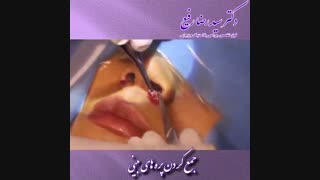 جمع کردن پره های بینی | دکتر سید رضا رفیع | بهترین جراح بینی تهران اصلاح طرح لبخند