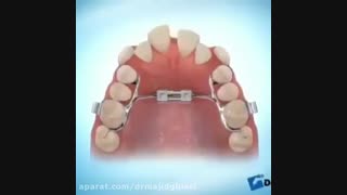 اصلاح طرح لبخند